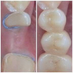 before-after photo implantacia-zuba