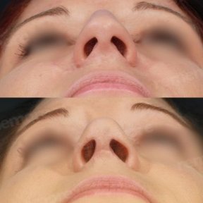 before-after photo septoplasty