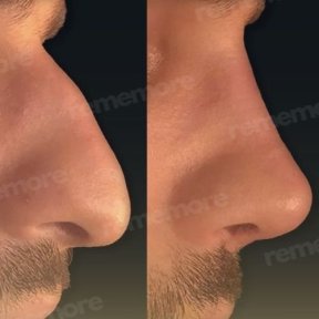 before-after photo septoplasty