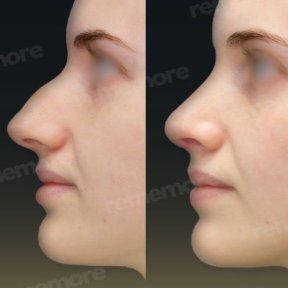 before-after photo septoplasty