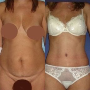 before-after photo liposuction