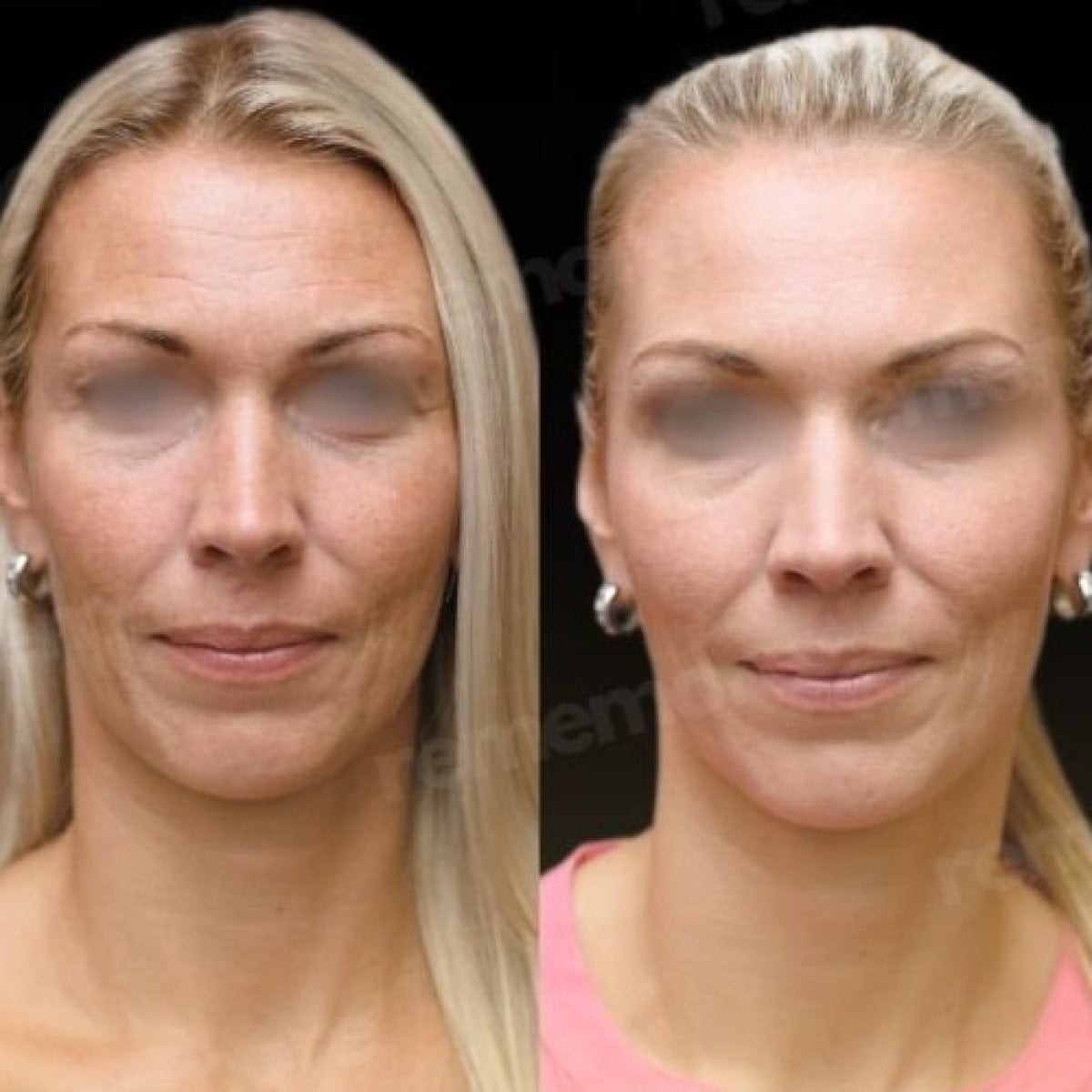 Resultados de lipofilling antes y después en Memorial Göztepe Hospital, restauración facial