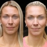 Before and after lipofilling results at Memorial Göztepe Hospital, facial volume restoration