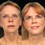 Before and after lipofilling results at Memorial Göztepe Hospital, facial rejuvenation visible