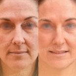 Before and after lipofilling results at Memorial Göztepe Hospital, facial rejuvenation visible