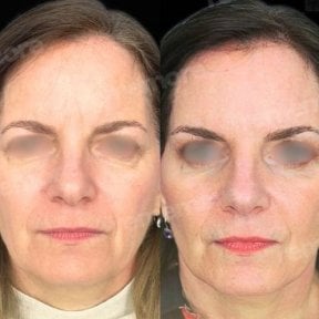 Vorher-nachher-Ergebnis Lipofilling im Gesicht bei Memorial Göztepe Hospital, verbesserte Kontur