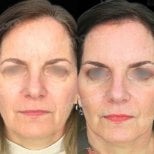 Before and after lipofilling results at Memorial Göztepe Hospital, facial fat grafting improvement