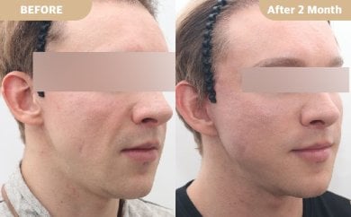 Stirnlift Vorher-Nachher-Ergebnis bei Dr. Tak Plastic Surgery, sichtbare Brauenanhebung