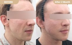 Stirnlift Vorher-Nachher-Ergebnis bei Dr. Tak Plastic Surgery, sichtbare Brauenanhebung