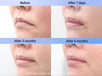 Résultats avant/après lip lift chez Dr. Tak Plastic Surgery – amélioration du contour des lèvres