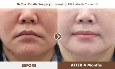 Résultats avant et après lifting des lèvres et coins de la bouche chez Dr. Tak Plastic Surgery