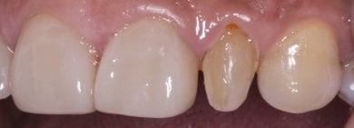 Przed założeniem licówek Emax w Wuhan Yiya Simei Dental Hospital, widoczne przebarwienie zęba