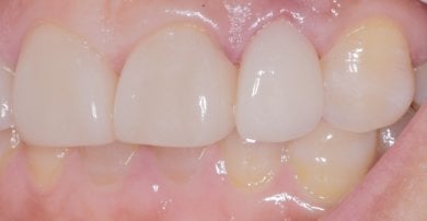 Efekt licówek Emax w Wuhan Yiya Simei Dental Hospital – naturalna metamorfoza uśmiechu