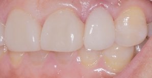 Efekt licówek Emax w Wuhan Yiya Simei Dental Hospital – naturalna metamorfoza uśmiechu