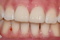 Efekt licówek Emax w Wuhan Yiya Simei Dental Hospital – poprawiona estetyka przednich zębów