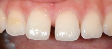 Efekt po licówkach Emax w Wuhan Yiya Simei Dental Hospital, poprawione przednie zęby