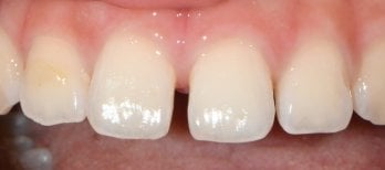 Efekt po licówkach Emax w Wuhan Yiya Simei Dental Hospital, poprawione przednie zęby