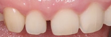 Efekt po licówkach Emax w Wuhan Yiya Simei Dental Hospital, poprawa przednich zębów