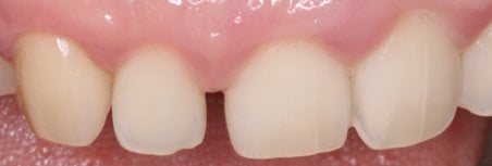 Efekt po licówkach Emax w Wuhan Yiya Simei Dental Hospital, poprawa przednich zębów