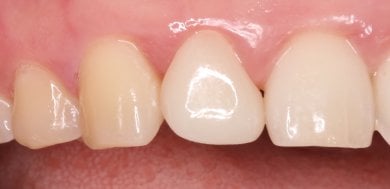 Efekt licówki Emax na przednim zębie w Wuhan Yiya Simei Dental Hospital