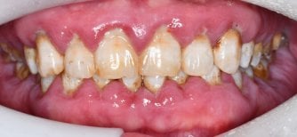 Antes de la gingivectomía en Shanghai Y+bo Dental Clinic, sobrecrecimiento gingival y placa