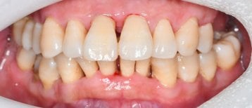 Antes de la gingivectomía en Shanghai Y+bo Dental Clinic, exceso de encía en dientes superiores
