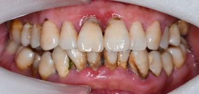 Antes de gingivectomía en Shanghai Y+bo Dental Clinic, sobrecrecimiento gingival y sarro visible