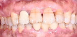 Antes de la gingivectomía en Shanghai Y+bo Dental Clinic, exceso de encía y línea desigual