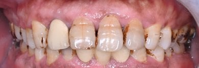 Resultados de gingivectomía en Shanghai Y+bo Dental Clinic, mejora de encías y salud oral