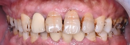 Resultados de gingivectomía en Shanghai Y+bo Dental Clinic, mejora de encías y salud oral