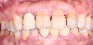 Resultado antes de gingivectomía en Shanghai Y+bo Dental Clinic, exceso de encía visible