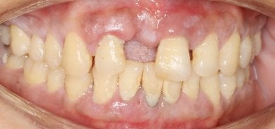 Resultado de gingivectomía en Shanghai Y+bo Dental Clinic, contorno de encías mejorado