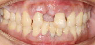 Resultado de gingivectomía en Shanghai Y+bo Dental Clinic, contorno de encías mejorado