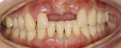 Resultado de gingivectomía en Shanghai Y+bo Dental Clinic con mejora del contorno gingival