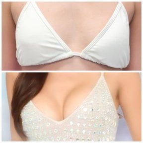 before-after photo breast-augmentation