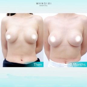 before-after photo breast-augmentation