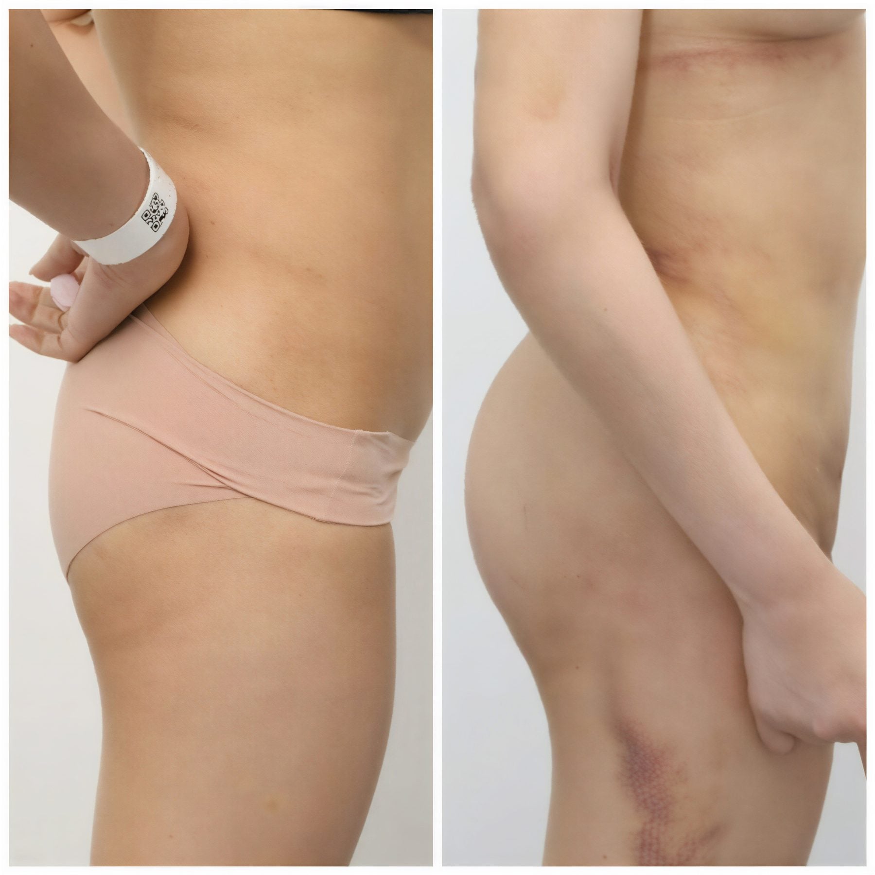 Resultados antes y después de Brazilian Butt Lift en Wansiri Hospital, glúteos realzados