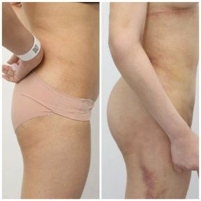 before-after photo brazilian-butt-lift