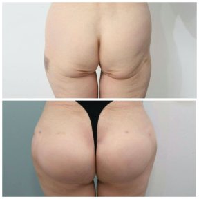 before-after photo brazilian-butt-lift