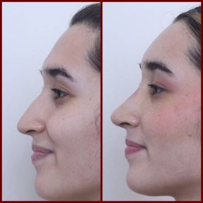 before-after photo rhinoplasty-nose-job
