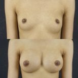 Résultats avant et après augmentation mammaire à Cosmacare Clinic Center for Aesthetic Medicine