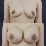 Résultat avant et après augmentation mammaire à Cosmacare Clinic Center for Aesthetic Medicine