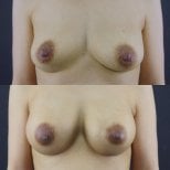 Résultats avant et après augmentation mammaire à Cosmacare Clinic Center for Aesthetic Medicine