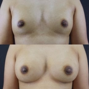 Résultats avant et après augmentation mammaire à Cosmacare Clinic Center for Aesthetic Medicine