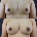 Résultats avant et après augmentation mammaire à Cosmacare Clinic Center for Aesthetic Medicine