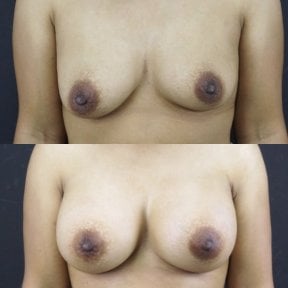 Résultats avant et après augmentation mammaire à Cosmacare Clinic Center for Aesthetic Medicine