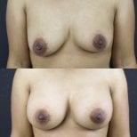 Résultats avant et après augmentation mammaire à Cosmacare Clinic Center for Aesthetic Medicine