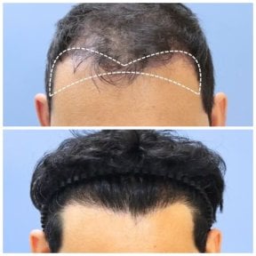before-after photo hair-transplant
