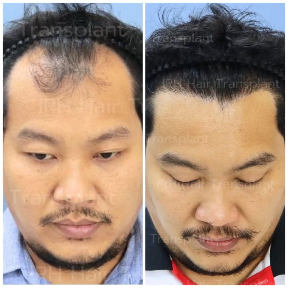 نتائج زراعة الشعر قبل وبعد في مستشفى إنترارات، استعادة خط الشعر لدى رجل