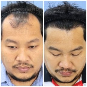 before-after photo hair-transplant